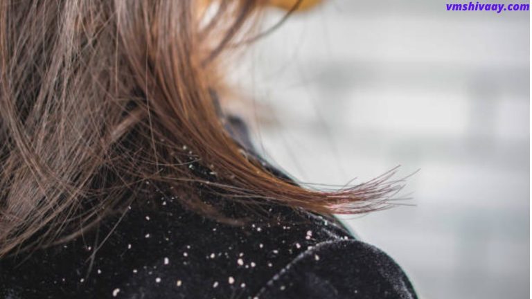 Home Remedies For Dandruff